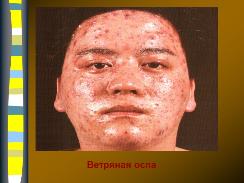 Ветряная оспа